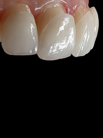 veneers